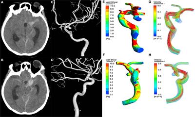 Rupture Risk Assessment for Mirror Aneurysms with Different Outcomes in the Same Patient